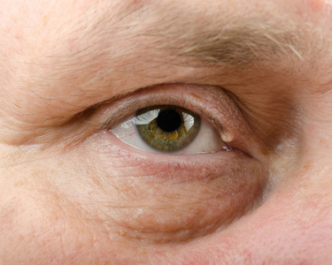 人的眼睑囊肿右眼睑