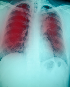胸部 x 光检查