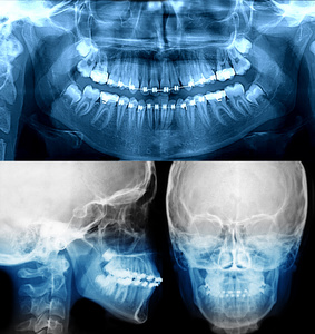 x 射线与正畸治疗的牙齿矫正