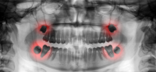 牙科扫描射线照相