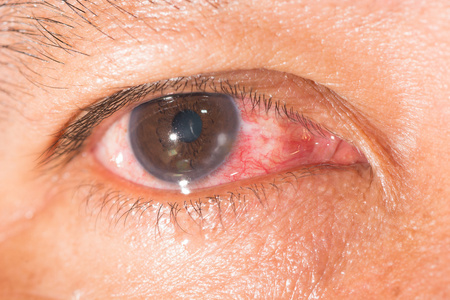 边际角膜炎眼试验