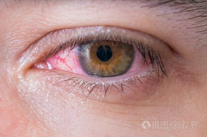 结膜炎红眼睛的宏
