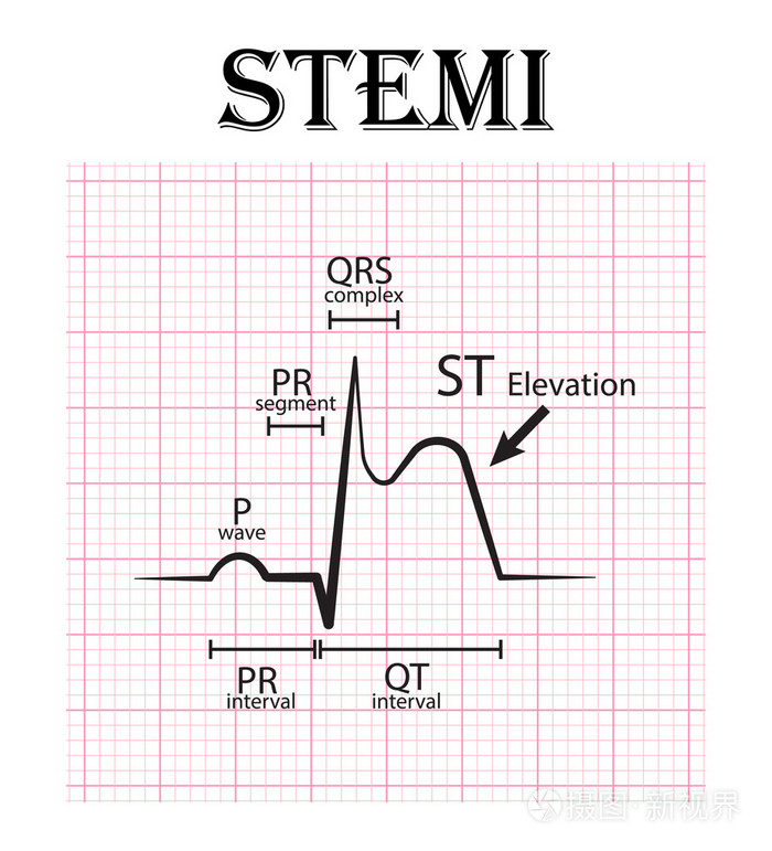 心电图的 st 抬高心肌梗死 (stemi) 和心电图的细节 (p 波,pr 段,pr