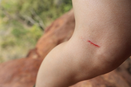 受伤的岩石登山者双腿图片