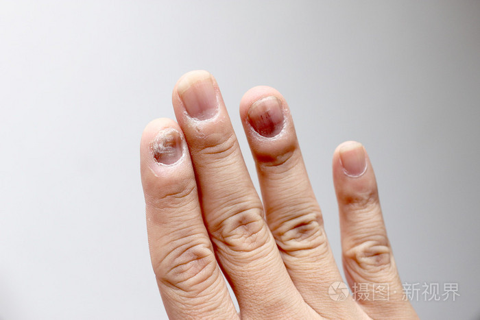 指甲上的真菌感染,手指上的真菌感染-软焦点