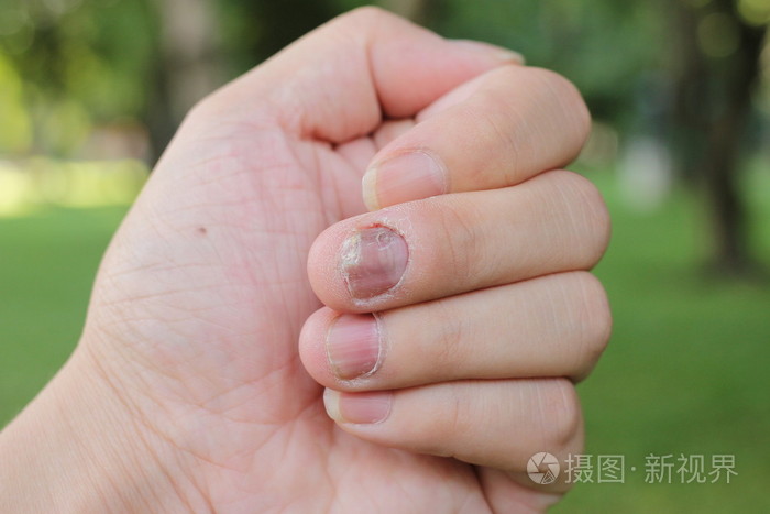 指甲上的真菌感染,手指伴有真菌病.