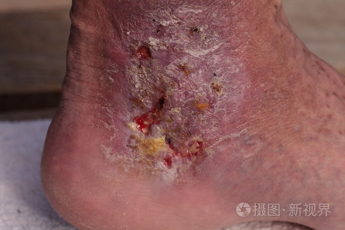 医学图片: 对皮肤的踝关节感染蜂窝织炎