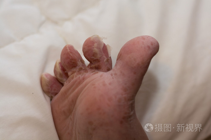 疾病后皮肤通过足部特写-特写