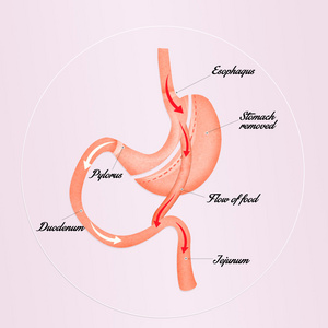 胃旁路手术方案图片