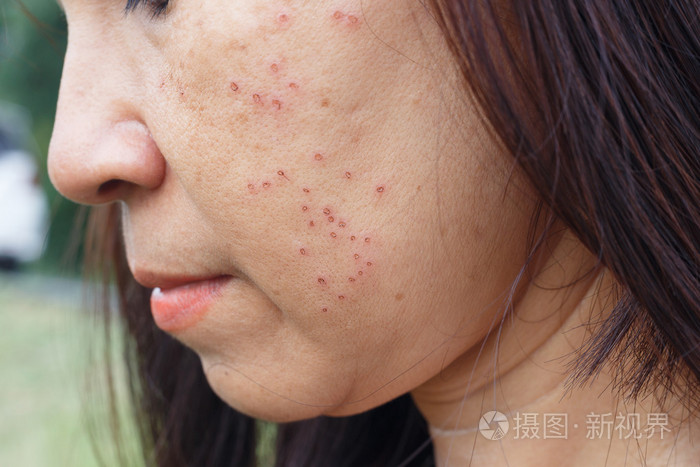 激光所致的面部女人割伤治疗痤疮