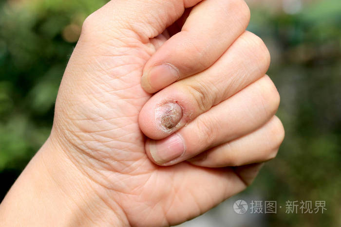 指甲源真菌感染, 手指甲真菌病