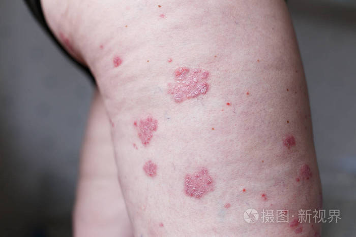 过敏性皮疹皮炎湿疹皮肤病人的腿.银屑病和湿疹皮肤有