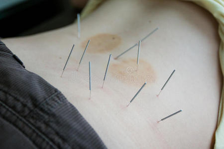 中国针灸背部治疗