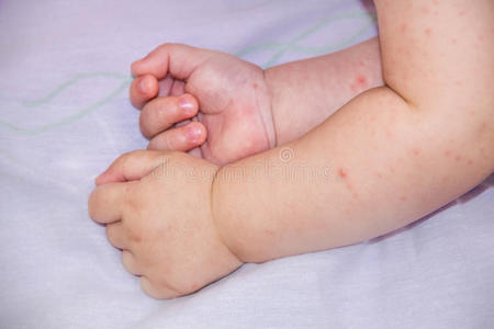 婴儿皮炎皮疹问题。 因食物过敏而过敏。 皮肤脸颊上的特写特应性症状