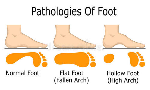 鞋跟 足迹 皮肤 曲线 鞋底 高的 疾病 扁平足 医疗保健