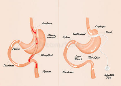 胃旁路和胃带
