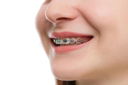 特写彩色牙套在牙齿上。 美丽的女性微笑肖像与自锁支架。 正畸治疗。