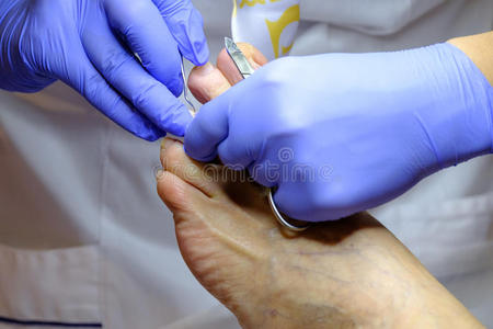 手套 指甲 照顾 白种人 身体 医生 足部护理 剥皮 医学