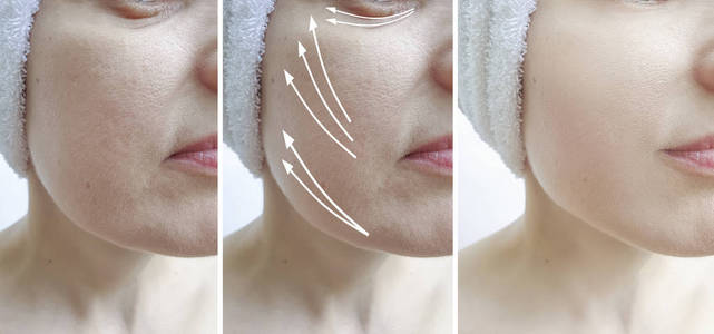 皮肤 再生 塑料 拧紧 校正 对比 老化 女人 医学 成熟