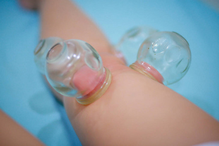 Chinese medicine science is a method of treatment using Cupping 