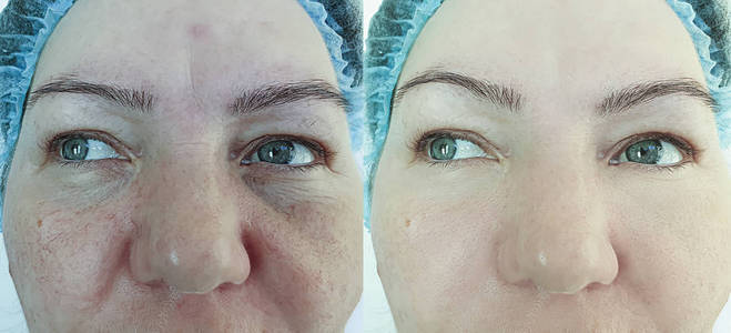 医学 塑料 治疗 眼睑成形术 返老还童 皮肤 眼睛 填料