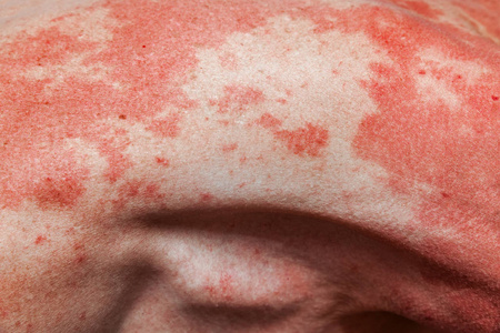 皮肤对人体过敏。抽象受损皮肤背景