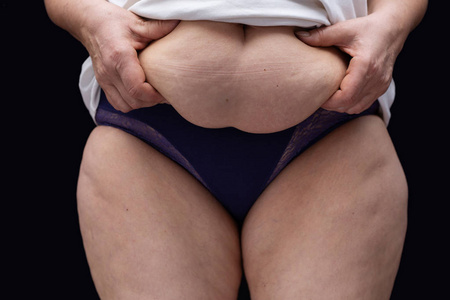 肥胖女性腹部脂肪团图片