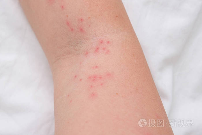 女性手臂上的皮疹过敏反应引起的瘙痒丘疹反应过敏概念和皮肤病学