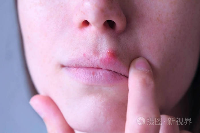 人类嘴唇上的疱疹病毒女人摸嘴唇上的疱疹疮特写