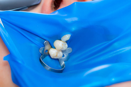 特写乳胶板设计用于在治疗期间将要治疗的牙齿与口腔的其他部分隔离。