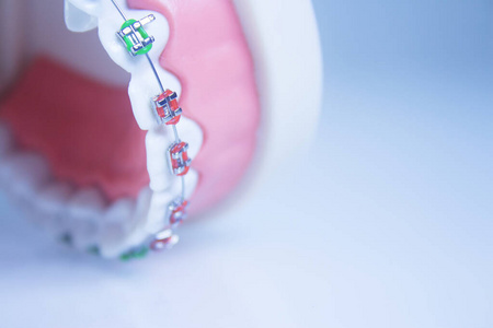 装置 照顾 牙医 支撑 义齿 正畸 示范 医学 正畸学 牙齿