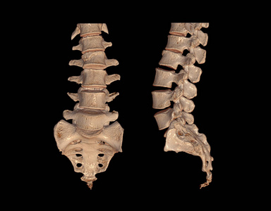 三维渲染 计算机断层扫描 背痛 检查 形象 外科手术 脊椎骨