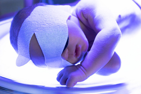 婴儿因黄疸躺在紫外线灯下图片