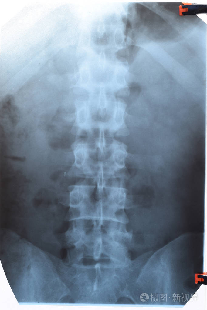 腰椎x光片