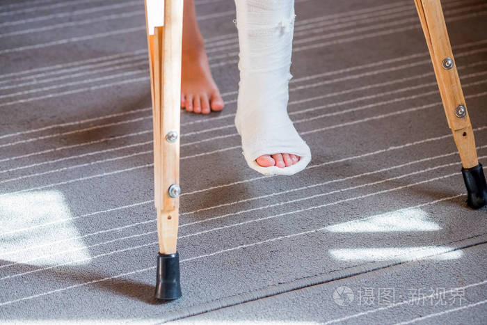 腿断了,成了无法辨认的小石膏孩子.年轻骨科女孩在家里拄着拐杖.