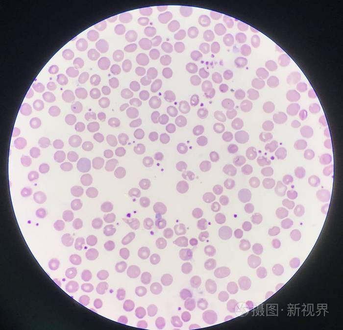 血涂片显示血小板增多