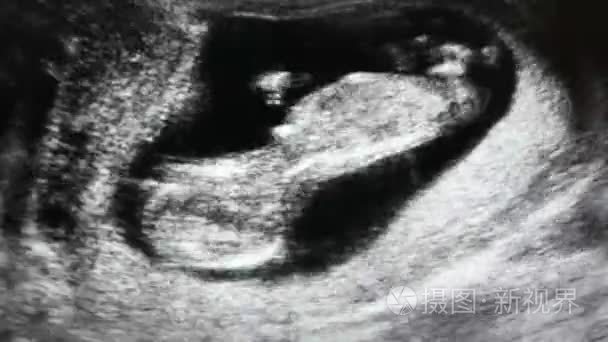 超声波扫描的人类胚胎