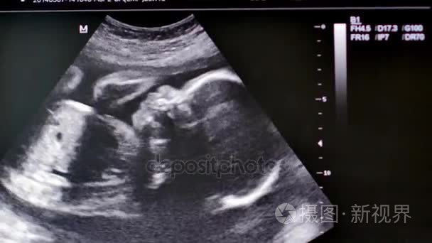 监测与医学超声扫描的人类婴儿。4 k Ultrahd 视频