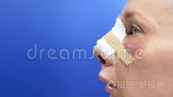 现实形象。 鼻成形术后第二天女性面部。