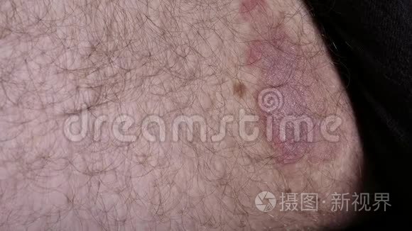 男性腿部皮肤真菌感染视频