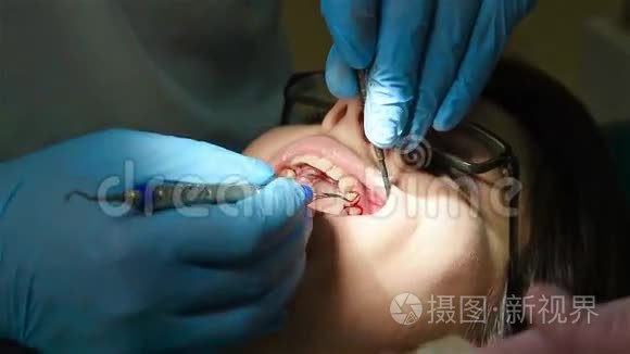 牙医做牙齿视频