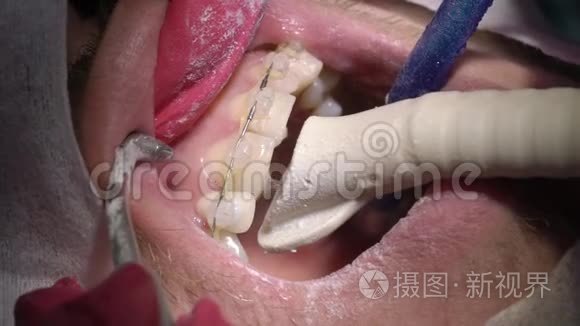 牙医为病人做牙齿清洁视频