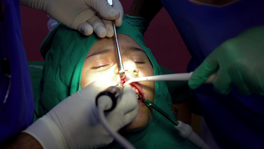 口腔口腔外科手术牙牙胶切除视频