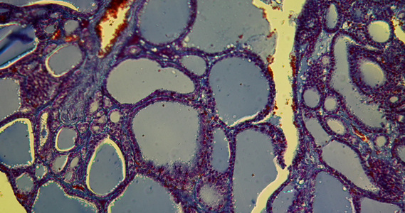 甲状腺肿胶体甲状腺肿病视频