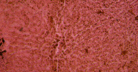 肝脏的色素硬化视频