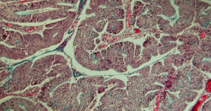 显微镜下的结肠癌疾病24秒视频