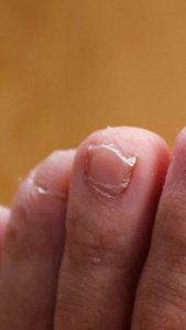 脚气灰指甲皮肤病皮肤干裂脚指头视频