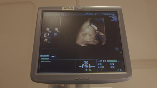 怀孕B超超声波孕妇怀孕视频