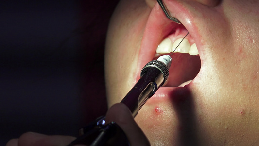带注射器针头的牙医在口腔手术前对牙道进行消毒视频