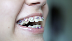 可爱孩子的肖像牙齿牙套微笑30秒视频